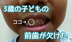 3歳子どもが転んで前歯が欠けてしまった！すぐに歯医者さんへ行こう